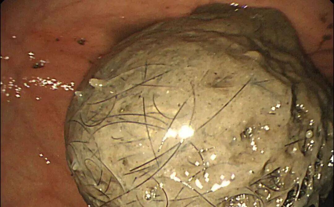 皇冠信用網在线注册_发现一例皇冠信用網在线注册，10岁女孩确诊！已有多起病例，有人因羞耻感延误就医