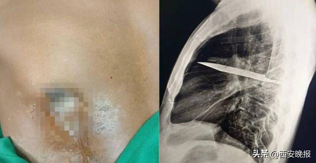 皇冠登3管理出租
_罕见!坦桑尼亚44岁男子胸口流脓发出恶臭皇冠登3管理出租
,照X光才发现有把刀在体内长达8年,刚好避开心脏血管